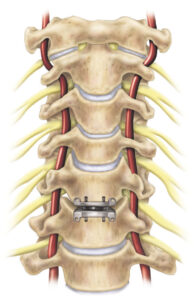 Cervical Disc Replacement