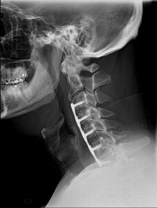 Cervical Spine Fusion Surgery