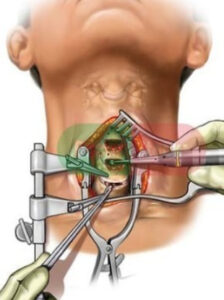 Cervical Spine Surgery