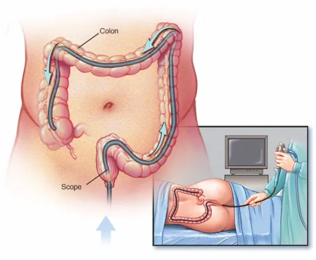 Colonoscopy