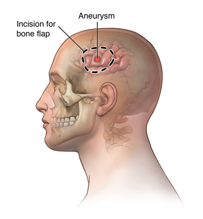 Cranial Surgery