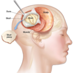 Craniotomy