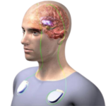 Deep Brain Stimulation (DBS)