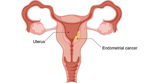 Why Choose Universal Hospital for Endometrial Cancer Care: