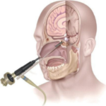 Endoscopic Brain Surgery