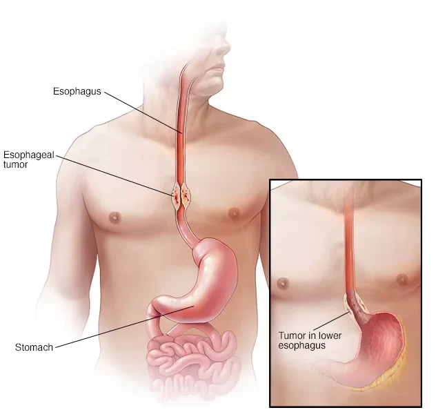 Esophageal Cancer