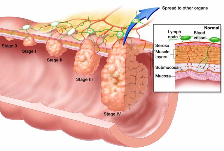 Esophageal Cancer stages