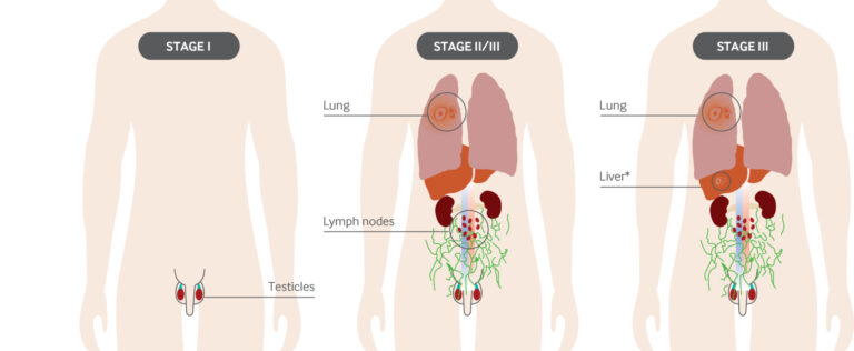 Testicular cancer stages