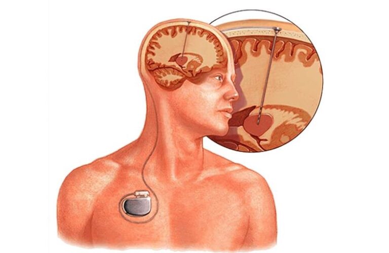 Functional Neurosurgery