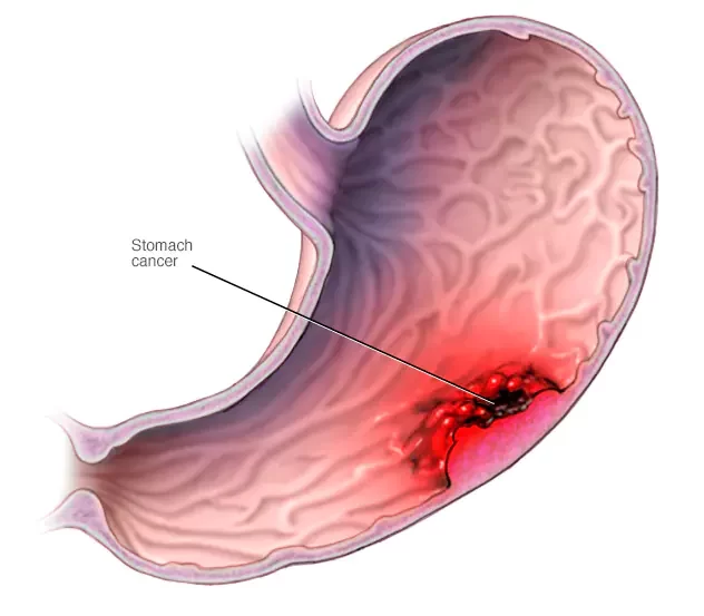 Gastric Cancer