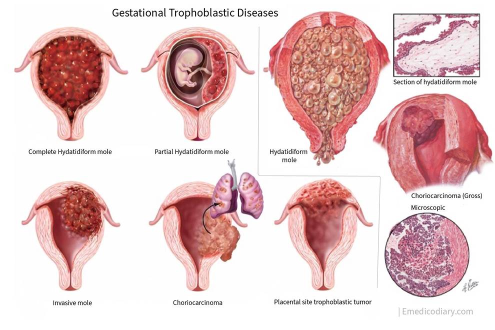 Gestational Trophoblastic Disease (GTD)