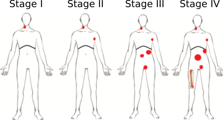 Hodgkin's lymphoma stages