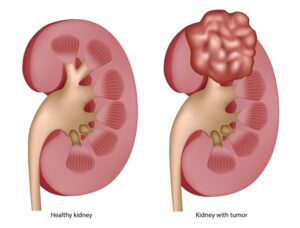 Kidney-Cancer