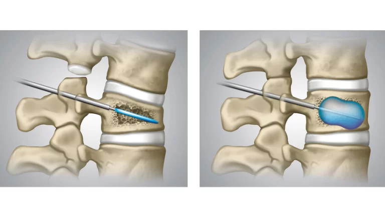 Kyphoplasty