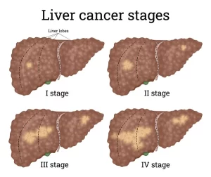 Liver cancer stages