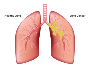 Lung Cancer