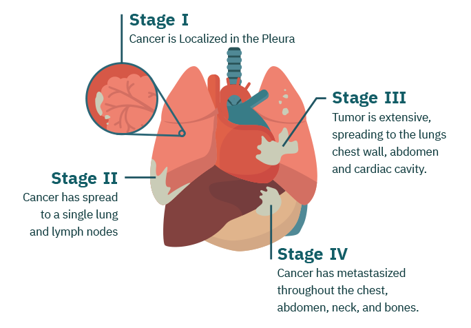 Mesothelioma