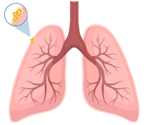 Mesothelioma