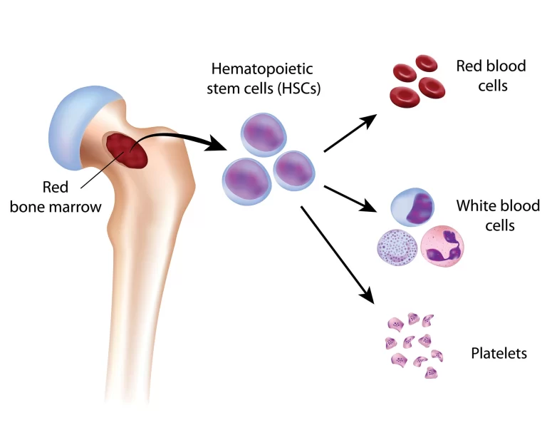 Myelodysplastic Syndrome