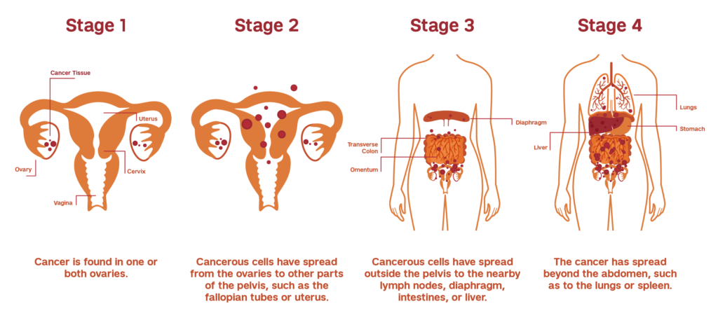 Ovarian Cancer stages