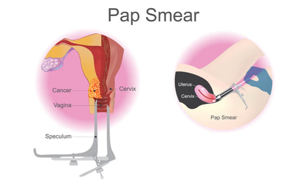 Pap-Smear - Cervical Cancer