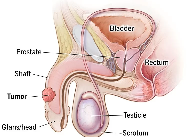 Penile Cancer