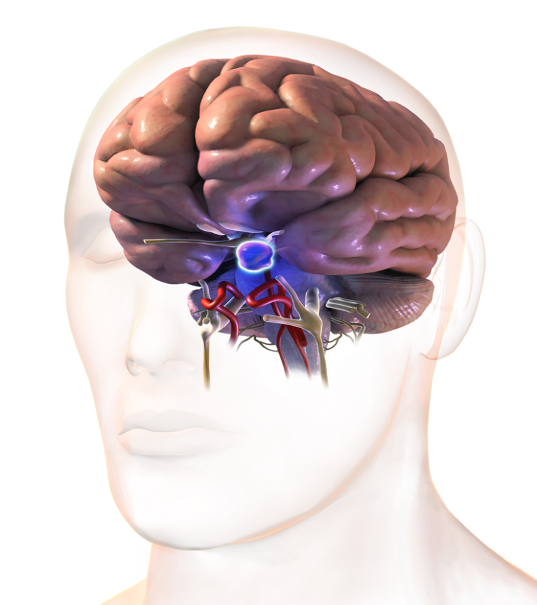 Pituitary Tumor