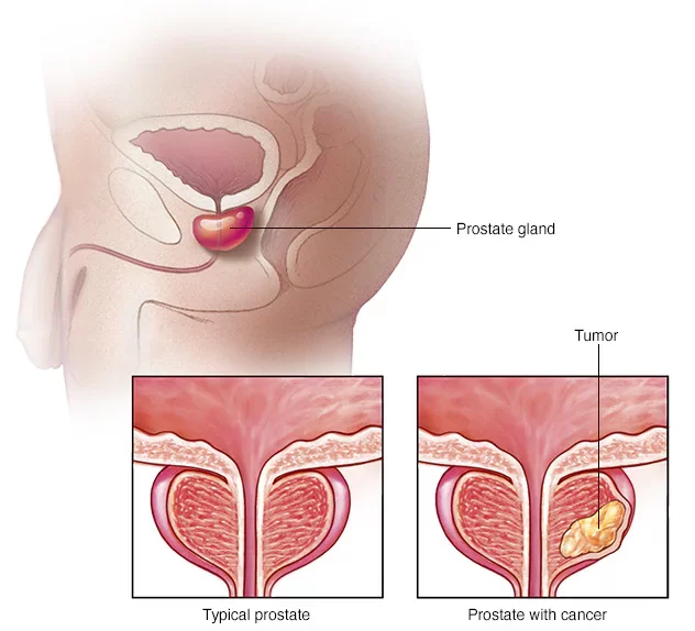 Prostate Cancer