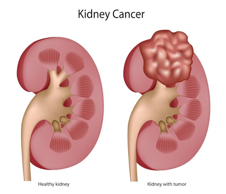 Renal Cancer