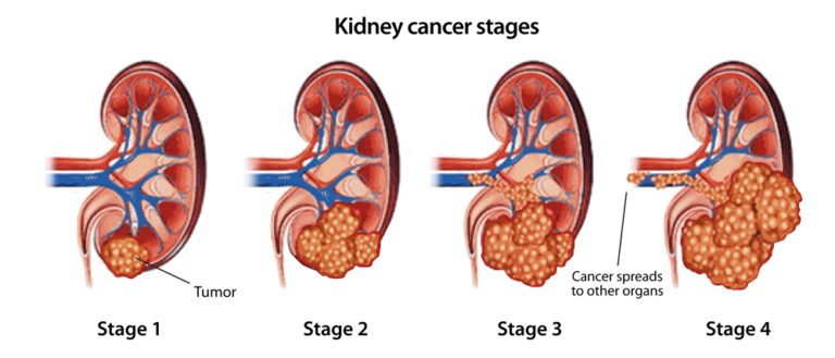 Renal Cancer stages