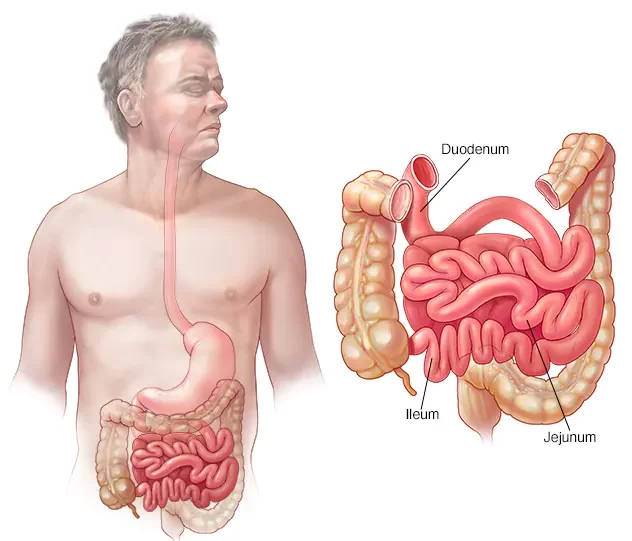 Small Intestine Cancer