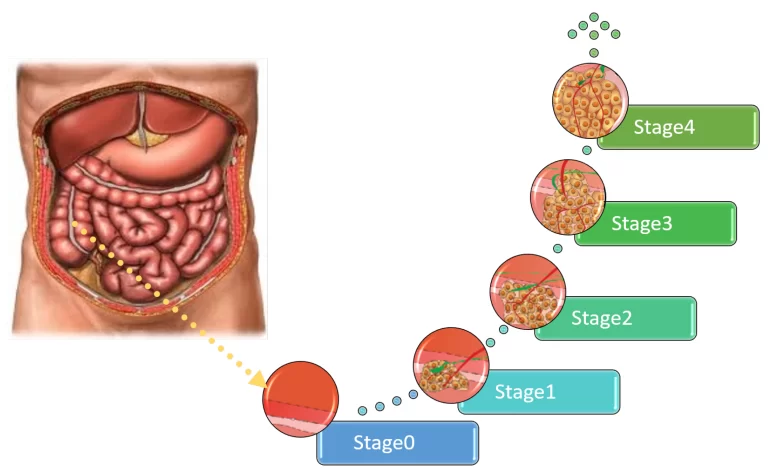 Small Intestine Cancer stages