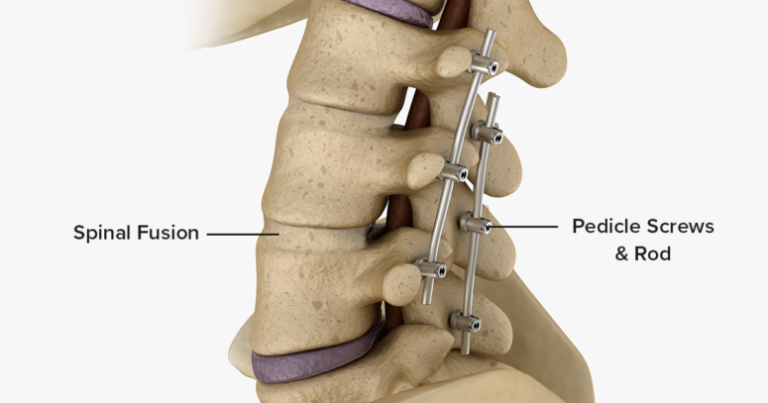 Spinal Fusion