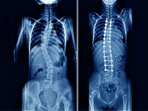 Lumbar Spine Fusion Surgery