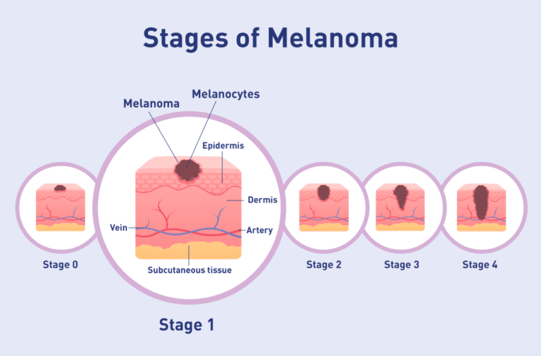 Melanoma stages