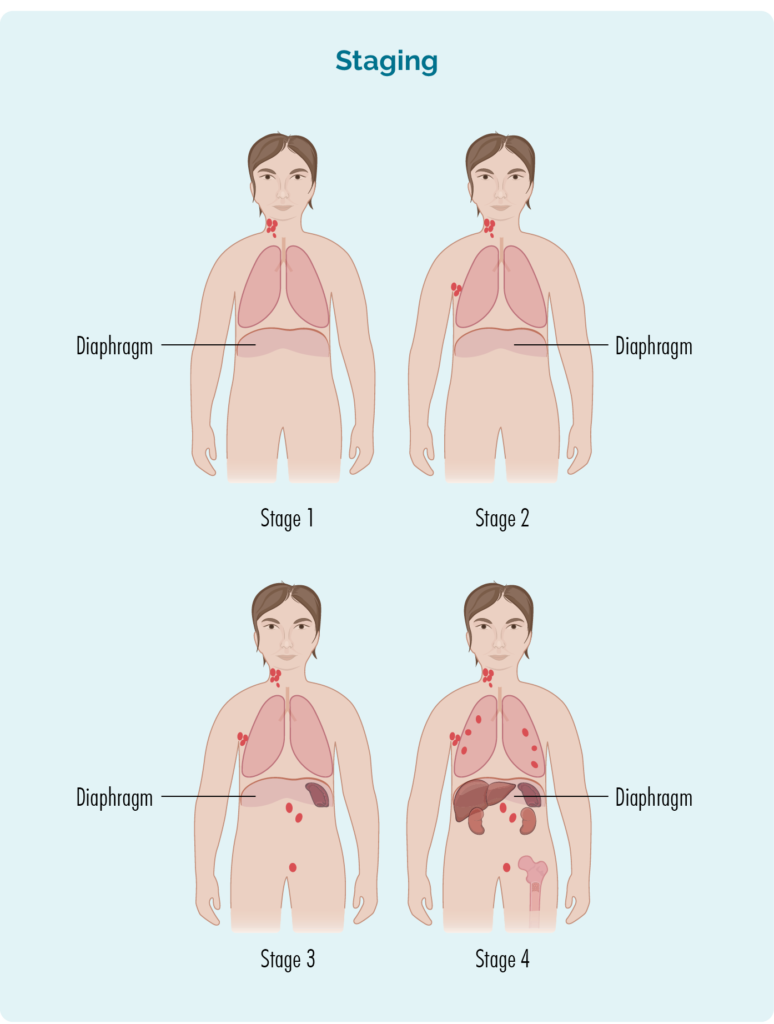 Non-Hodgkin's Lymphoma stages