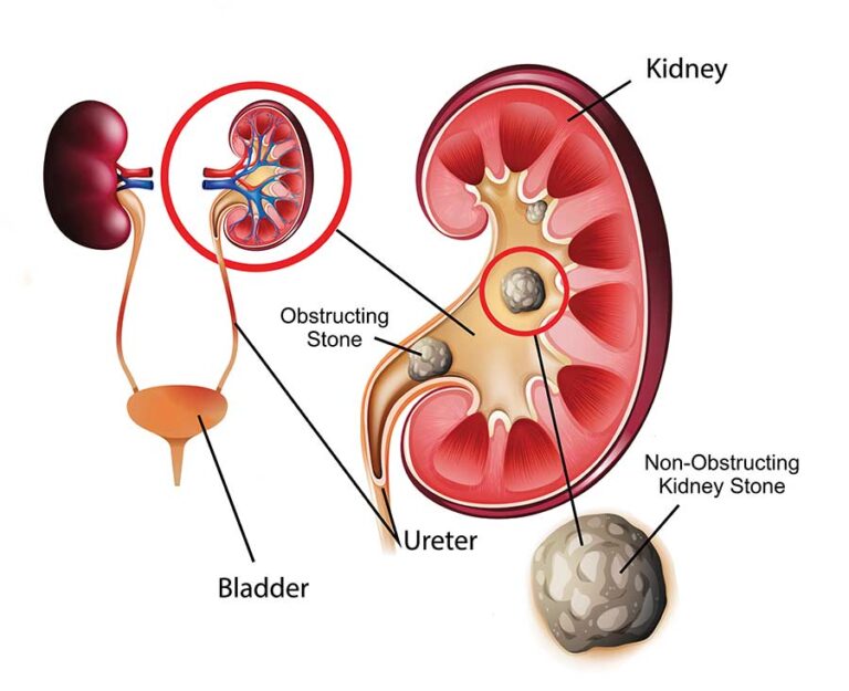 Kidney Stones