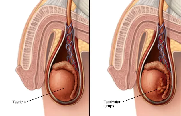 Testicular Cancer