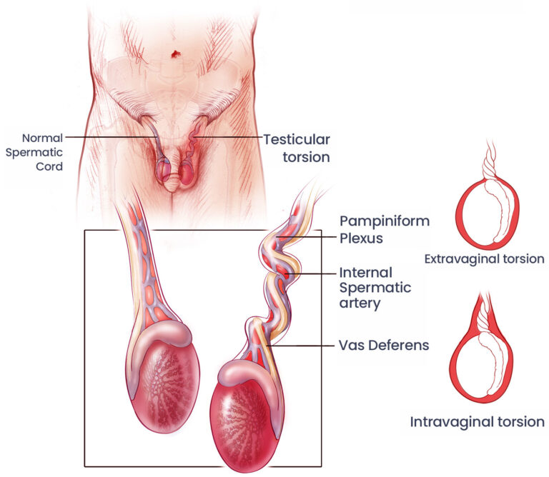 Testicular Surgery