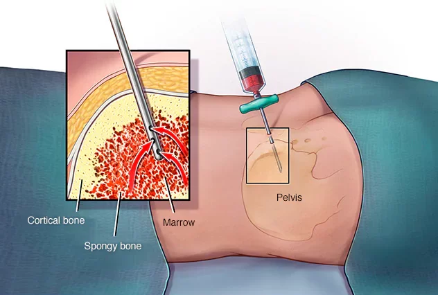 Treatment for leukemia