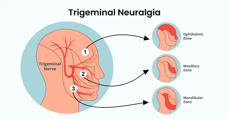 Trigeminal Neuralgia