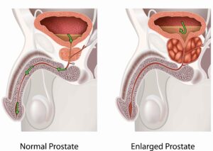 Prostate Surgery