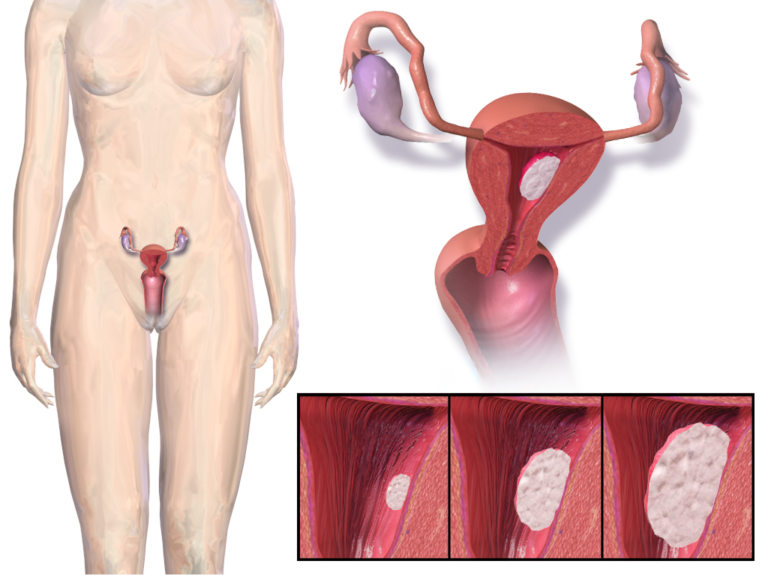 Uterine cancer