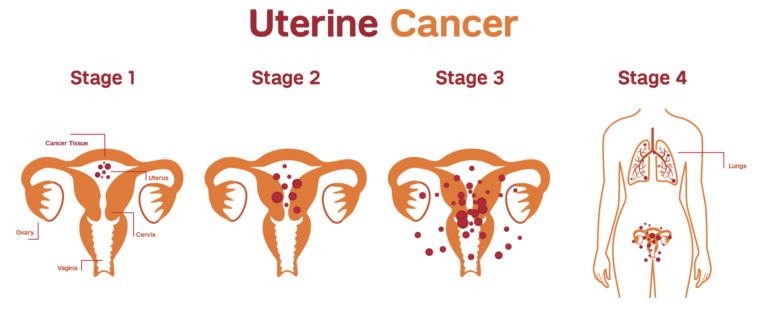 Uterine cancer Staging