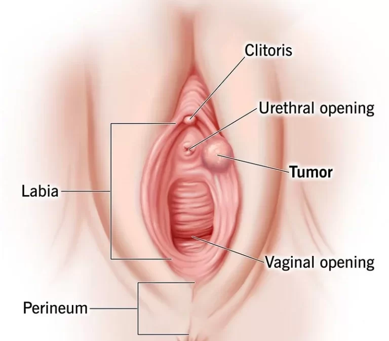 Vaginal cancer