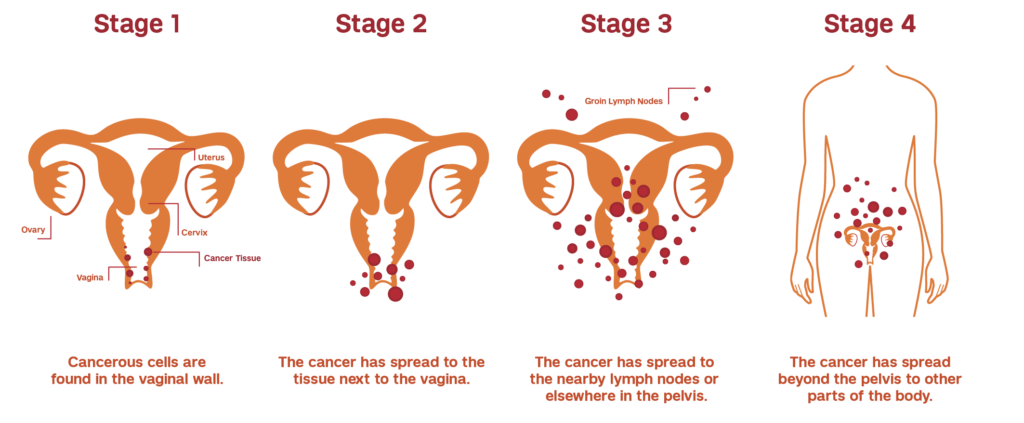 Vaginal cancer stages