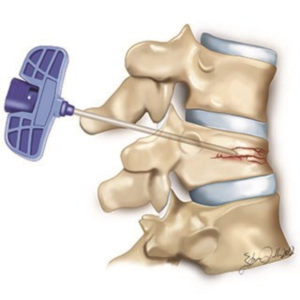 Vertebroplasty