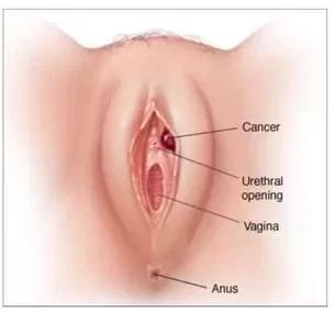 Vulvar Cancer