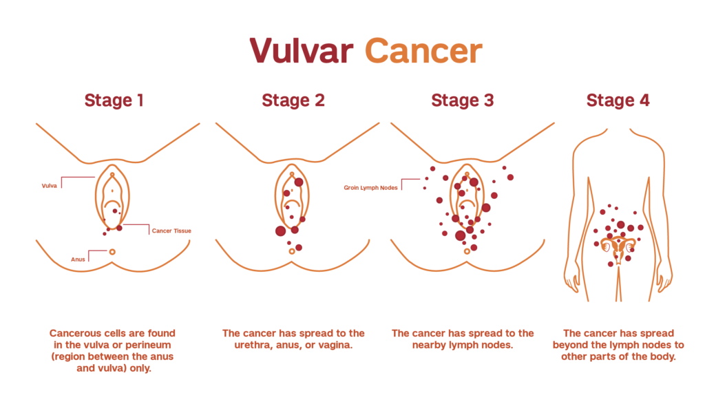 Vulvar Cancer stages