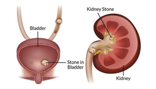 Bladder Stones